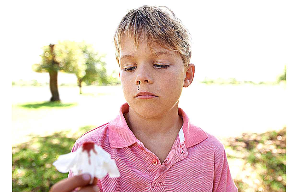nenäverenvuoto lapsella on yleinen vaiva