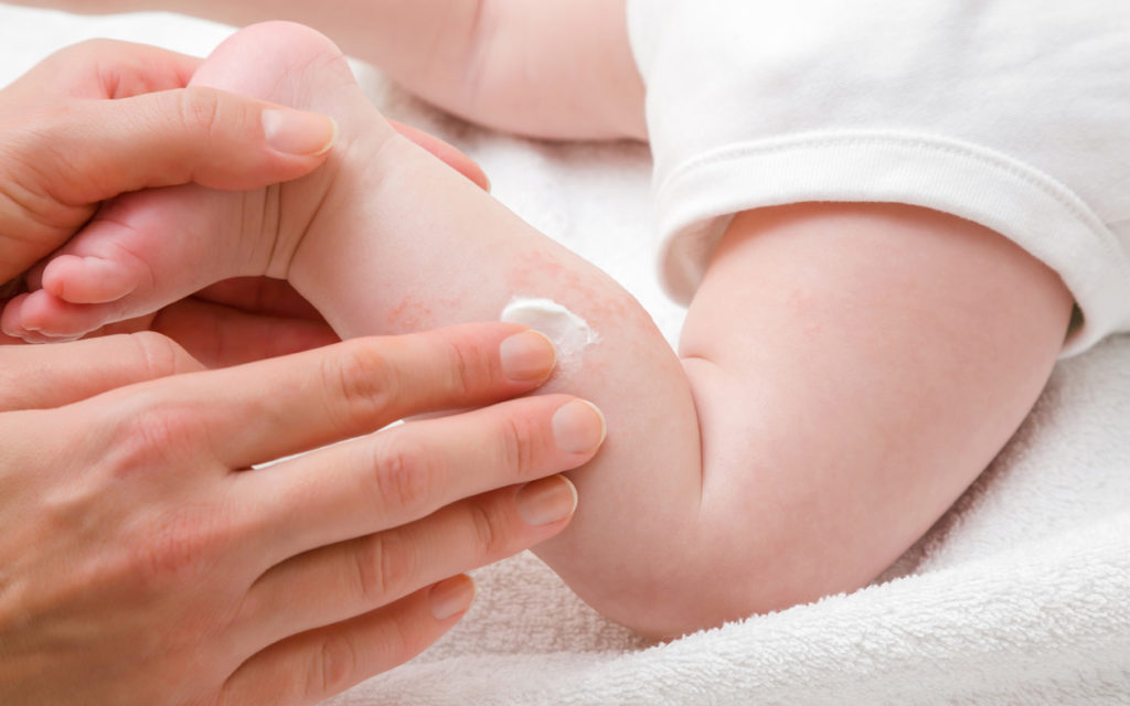Vauvoilla atooppinen ihottuma oireilee tyypillisesti muun muassa jaloissa.
