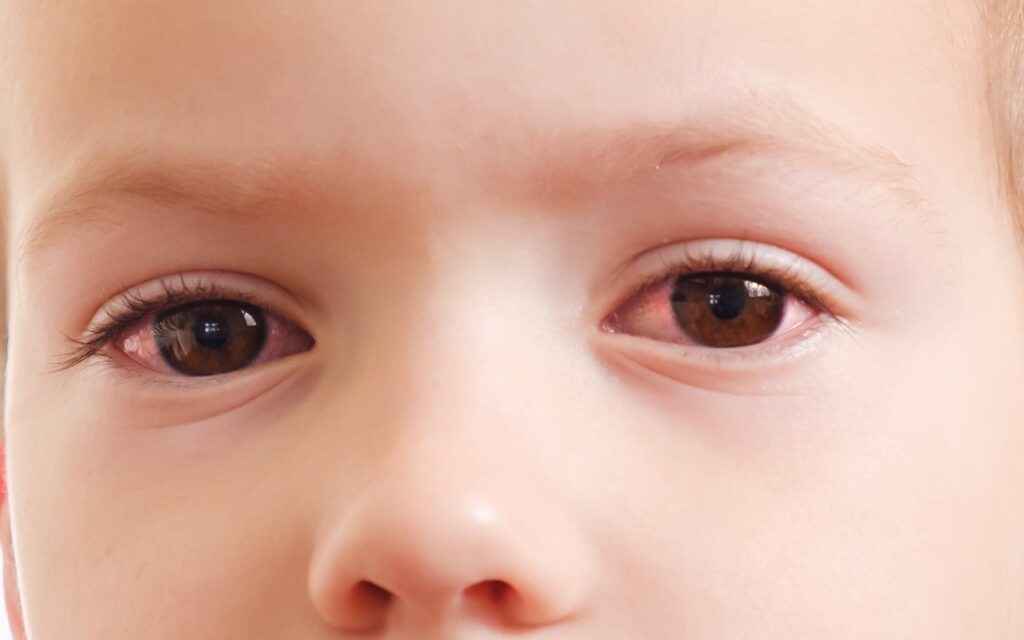 Lapsen silmätulehdus oireilee näkyvästi. Kuvassa lapsen silmät punottavat.