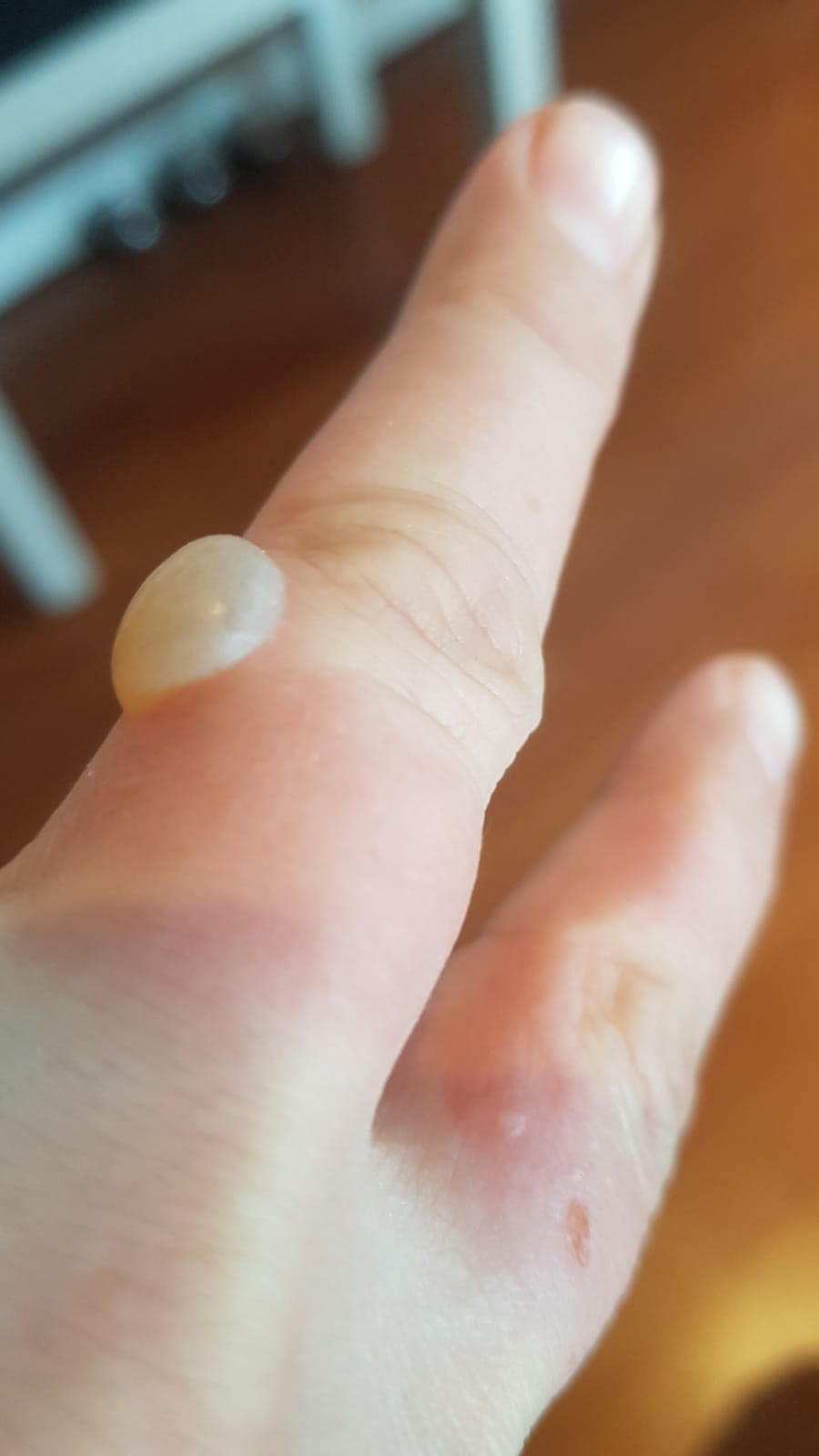 Raskauspemfigoidi: kuvassa sormi, jossa rakkula.