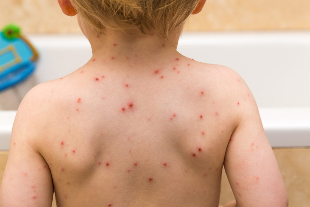 lasten rokkotaudit: lapsen selässä vesirokkoa