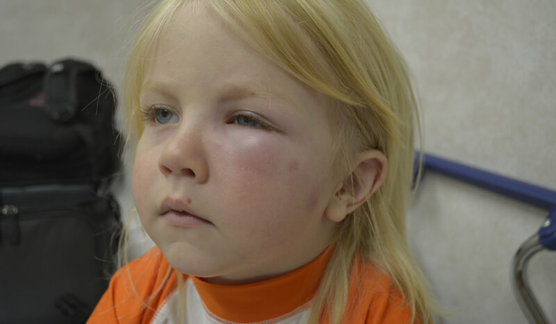 lapsen hyttysallergia: lapsen silmä muurautunut melkein umpeen
